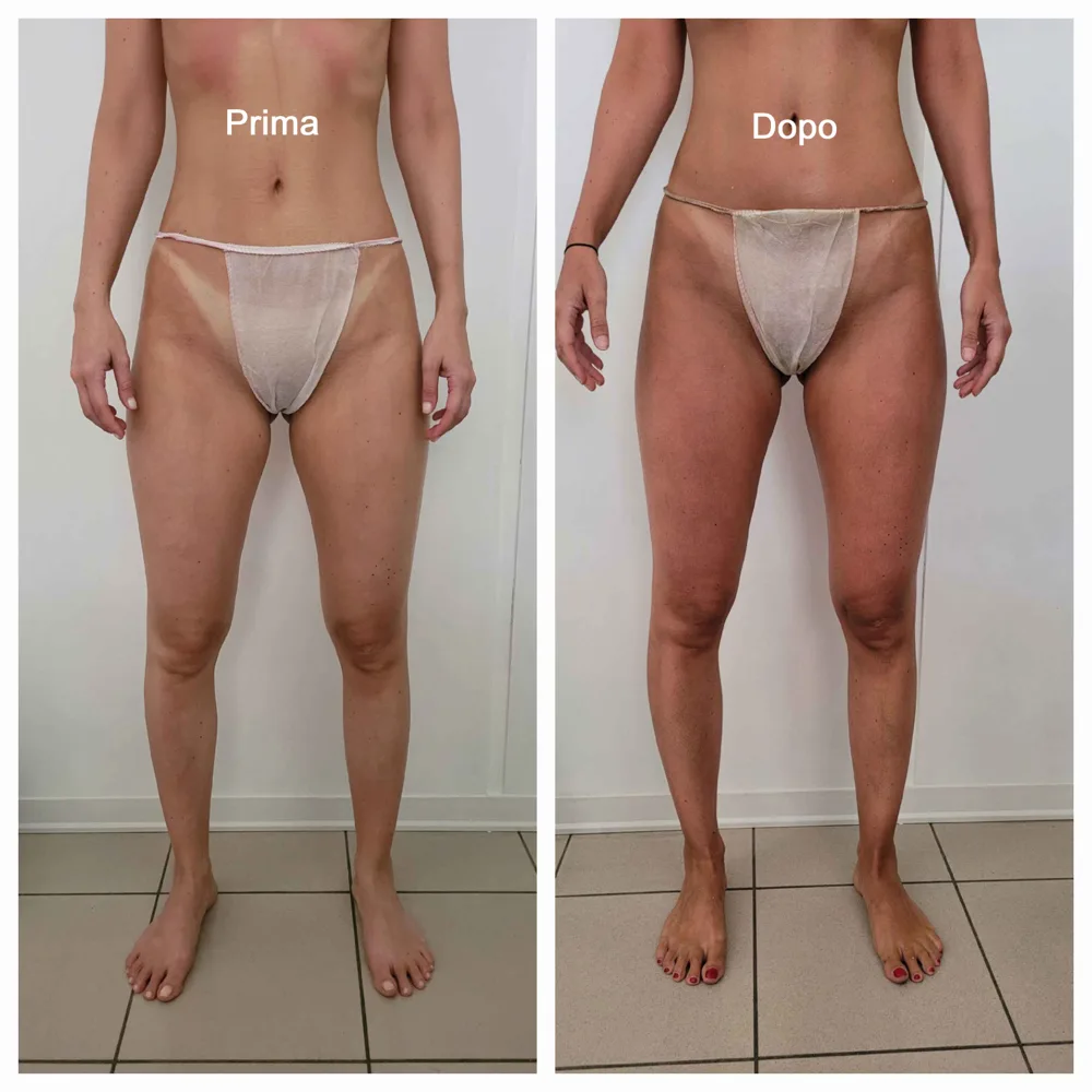Prima e dopo — risultato trattamento 1
