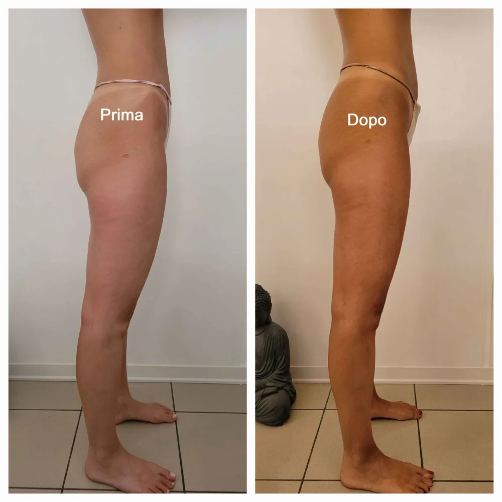 Prima e dopo — risultato trattamento 2