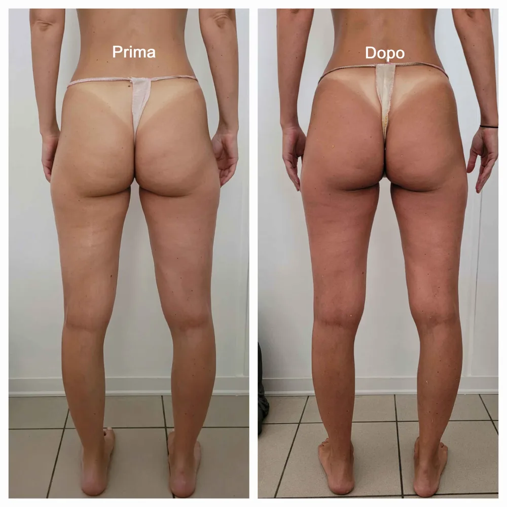 Prima e dopo — risultato trattamento 3