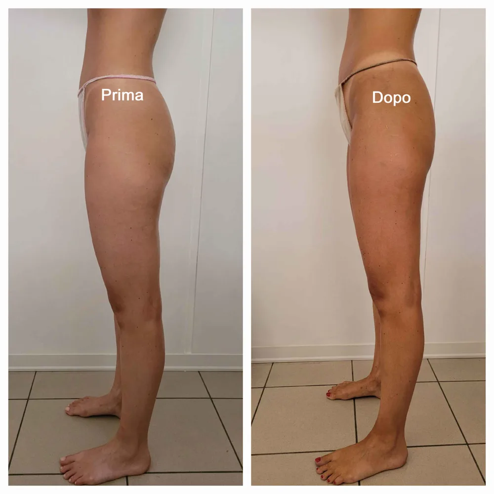 Prima e dopo — risultato trattamento 4